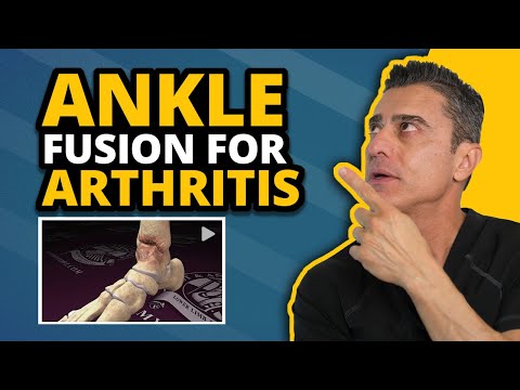 Ankle Fusion For Arthritis Explained
