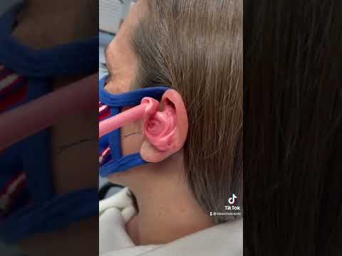 #billsmafia for the win 🤩 #earimpression #satisfying #earwax #audiologist #audiology #earwaxremoval