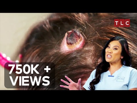 The Most Extreme Scalp Cyst EVER | Dr Pimple Popper | TLC
