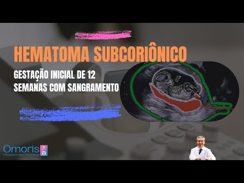 Pregnancy 12 weeks - What causes bleeding in early pregnancy?