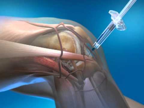 Knee Injection with Euflexxa - Non-surgical Knee Pain Relief
