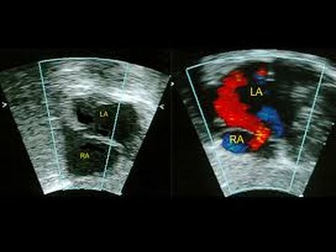 Pediatric Echo for the Adult Technologist: Introduction