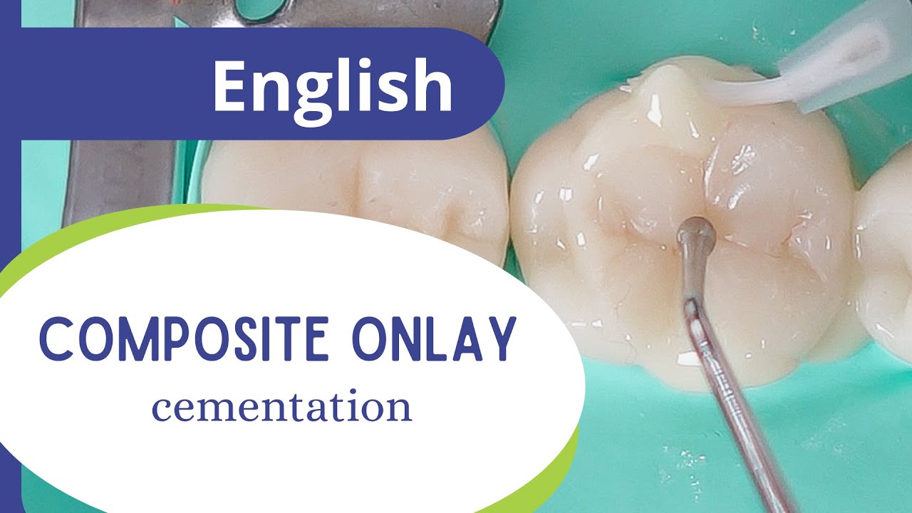 Composite onlay - part 5 final: cementation.