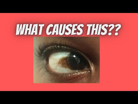 Causes of brown spot on eye | Patch | Discolouration|...