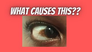 Causes of brown spot on eye | Patch | Discolouration| Pigment | Pterygium| Conjunctival Nevus