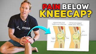 Hoffa’s Fat Pad Impingement: The Best Exercises to Reduce Anterior Knee Pain