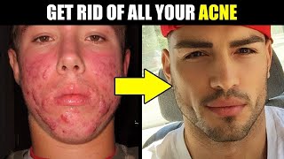 HOW to INSTANTLY ELIMINATE ACNE ... FAST! | How to Get Rid of Acne & Pimples