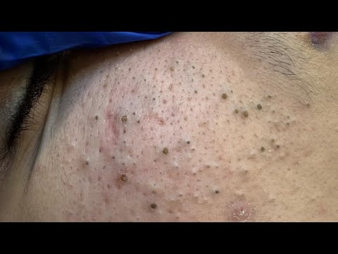 Deep Cleansing Facial Routine for Acne | Blackhead and Whitehead Removal