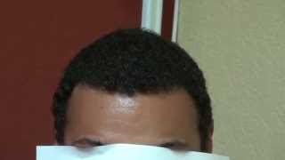 Dense Black Hair Transplant Hairline Restoration Result Bald Treatment Dr. Diep www.mhtaclinic.com