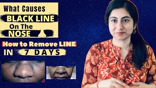 Black Line On The Nose And Pigmentation Home Remedy || How It Forms || Remove It In 7 Days