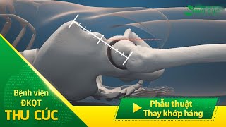 Phẫu thuật thay khớp háng tại BV Thu Cúc khôi phục khả năng vận động