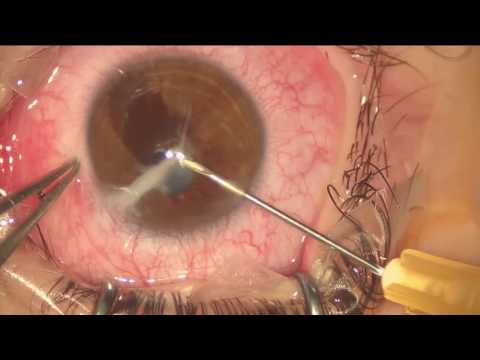 Queratoplastia por trauma ocular penetrante y afaquia en niño de 9 años