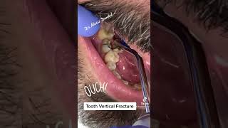 Vertical tooth fracture!do you have any root canal treated tooth? No Crown ?