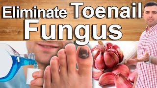 ELIMINATE TOENAIL FUNGUS NATURALLY - Home Remedies For Toenail Fungus and Athlete