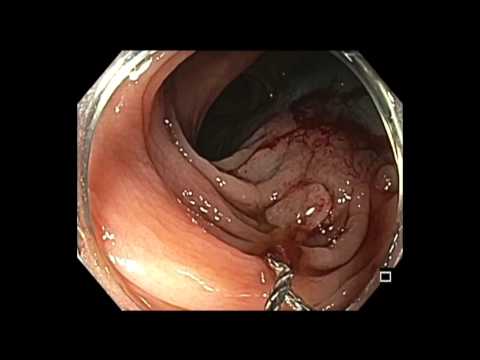 Colonoscopy: Transverse Colon - LST-NG Tumor - Resection