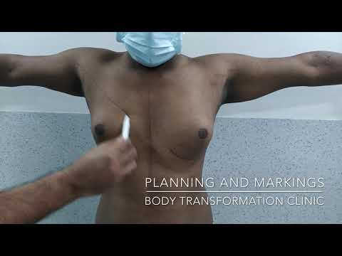 Patient Recovery Case — Video 17 (Tummy Tuck)