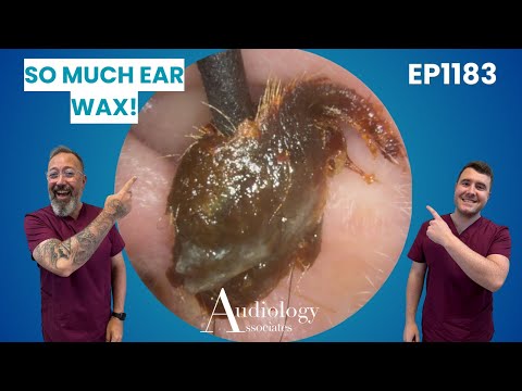 Deep, Dark, & Chunky! Satisfying Ear Wax Extraction - EP1183