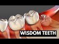 Wisdom Teeth Causes Symptoms And Treatment