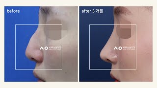 [시우전후사진] 매부리코성형/ 메부리코수술 전후사진