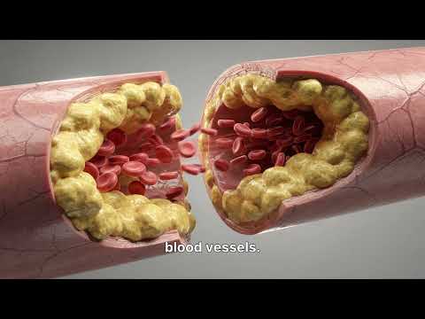 High Cholesterol: The Silent Warning Sign of Cardiovascular Disease