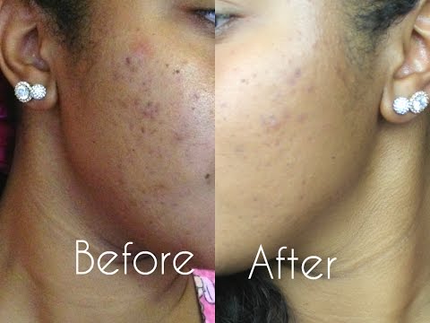 proactiv skin smoothing exfoliator