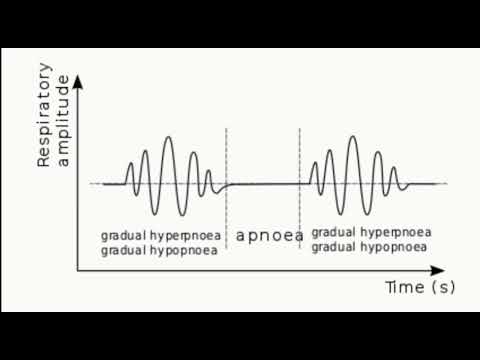 Cheyne stokes breathing in a patient with heart failure.