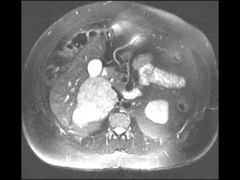 Adrenocortical Carcinoma
