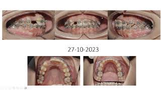 Tip lâm sàng chỉnh độ nghiêng răng cửa với dây Niti