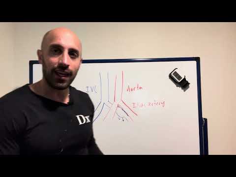 May Thurner Syndrome (Iliac vein compression syndrome)