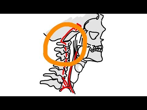 Studie: Chiropraktik und Schlaganfälle