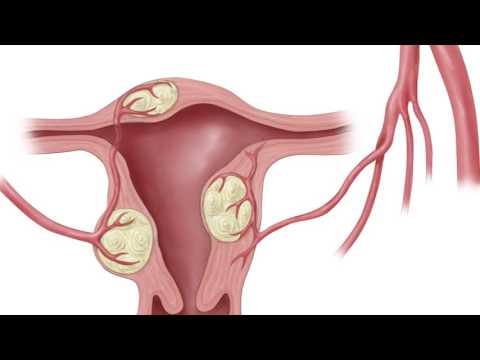 Trattamento succhi per il cancro alla prostata Microflora del tasso di secrezione prostata