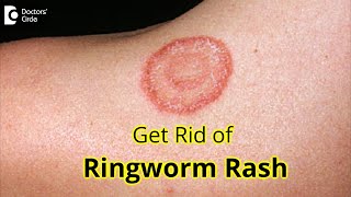 7 GREAT Tips for Prevention & Treatment of RINGWORM RASH- Dr. Amrita Hongal Gejje | Doctors