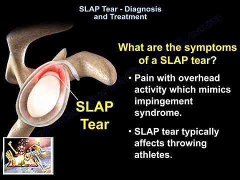 SLAP Tear Diagnosis & Treatment  - Everything You Need To Know - Dr. Nabil Ebraheim