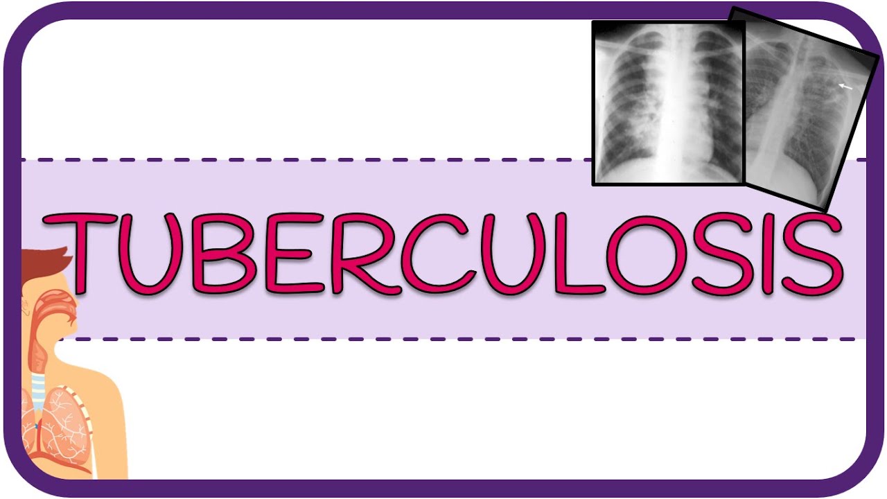 TUBERCULOSIS  - fisiopatología, microbiología, signos & síntomas y diagnóstico [ Aspectos Básicos ]
