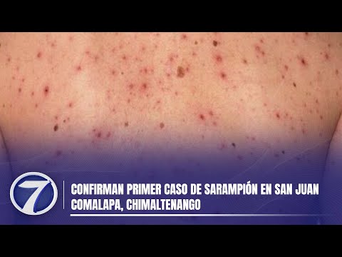 Confirman primer caso de sarampión en San Juan Comalapa, Chimaltenango