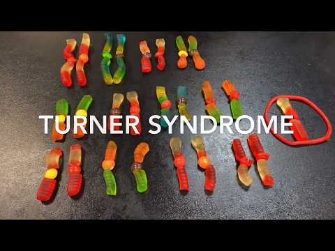 Turner Syndrome through Meiosis