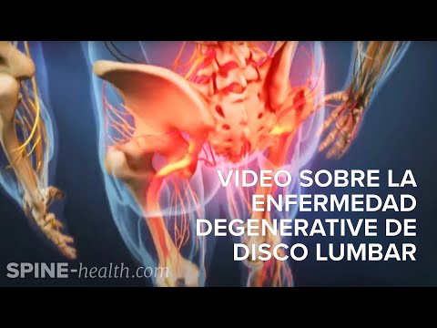 Video sobre la enfermedad degenerativa de disco lumbar