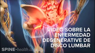 Video sobre la enfermedad degenerativa de disco lumbar