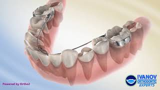Lingual Arch Appliance and Its Uses