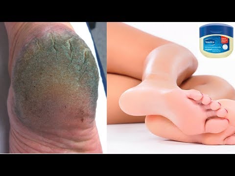 DO THIS SIMPLE HOME REMEDY WITH VASELINE TO GET RID OF CRACKED HEELS IN 3 DAYS