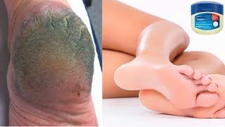 DO THIS SIMPLE HOME REMEDY WITH VASELINE TO GET RID OF CRACKED HEELS IN 3 DAYS
