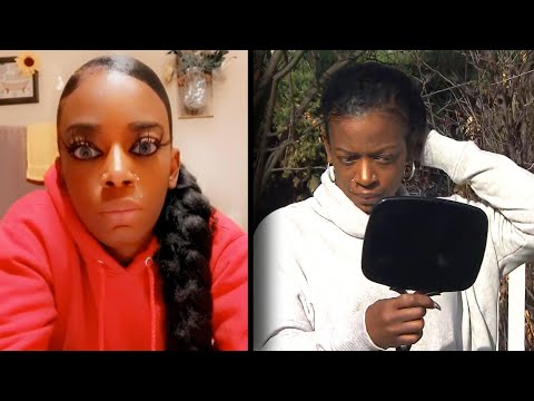 Tessica Brown’s Gorilla Glue Hair Nightmare Fixed by Surgeon