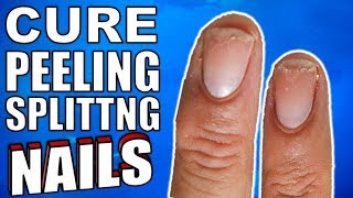 Why Are Your Nails Peeling & Splitting ? | How to Stop It For Good