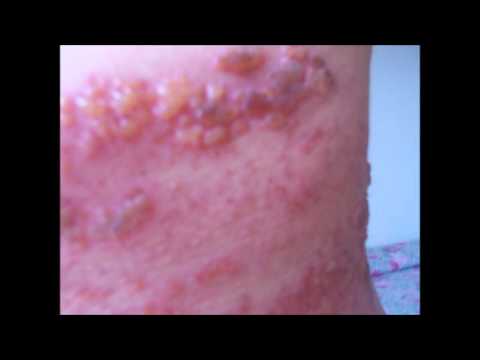 Solleticare e tosse con osteocondrosi cervicale Sigillare sotto la pelle sul finger joint