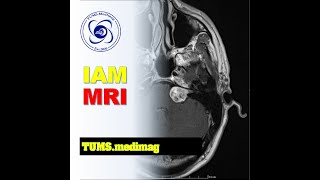 Download lagu Medimag: Planning and positioning in Internal Auditory Meatus (IAM) MRI mp3 Download lagu Medimag: Planning and positioning in Internal Auditory Meatus (IAM) MRI mp3
