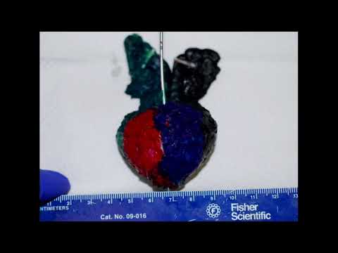 2017 Urology Symposium Day 1 Snippet 4