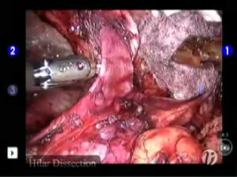 Robotic Kidney Surgery-Variation of techniques