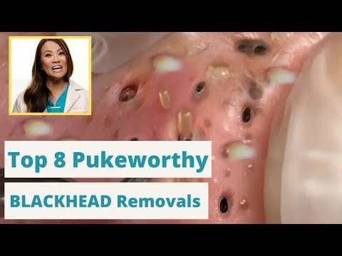 Dr  Pimple Poppers 8 WORST Blackhead Removals   You're not going to want to eat while you watch this