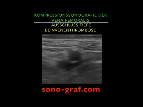 001 - Duplexsonografie - Vena femoralis