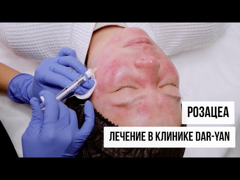 РОЗАЦЕА | ЛЕЧЕНИЕ В КЛИНИКЕ DAR-YAN